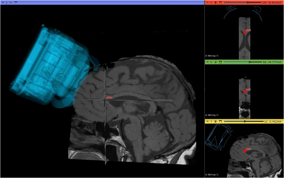 Openwater’s Open-LIFU desktop interface showing a 3D head model and MRI views